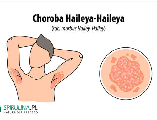 Choroba Haileya-Haileya